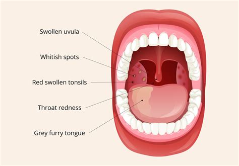 Tonsillitis .
